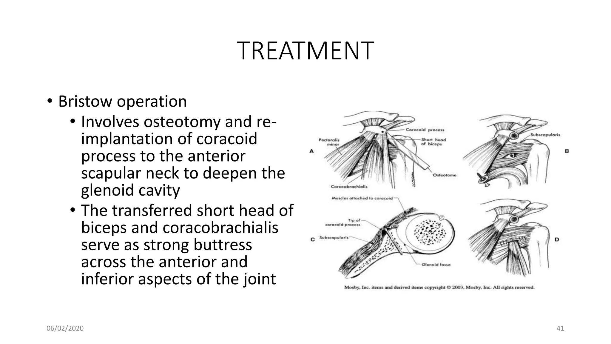 TREATMENT
• Bristow operation
• Involves osteotomy and re-
implantation of coracoid
process to the anterior
scapular neck to deepen the
glenoid cavity
• The transferred short head of
biceps and coracobrachialis
serve as strong buttress
across the anterior and
inferior aspects of the joint
06/02/2020 41
 