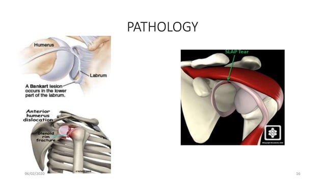 Pathological Shoulder Complex Pathology and management of recurrent shoulder dislocation | PPTX ...