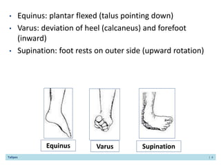 PATHOLOGY AND MGT OF CLUB FOOT.pptx