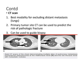 Contd
• CT scan
1. Best modality for excluding distant metastasis
(lungs)
2. Primary tumor site CT can be used to predict the
risk of pathologic fracture
3. Can be used to guide biopsy
 