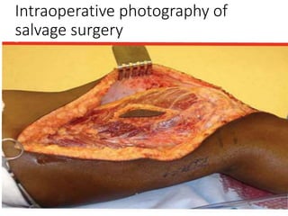 Intraoperative photography of
salvage surgery
 