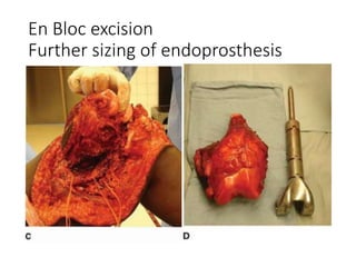 En Bloc excision
Further sizing of endoprosthesis
 