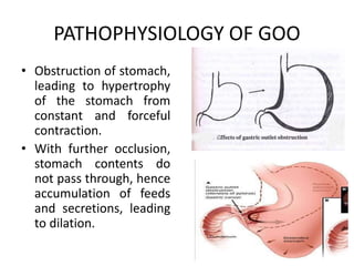Gooss Pathology and pathophysiology of Gatric Outlet Obstruction (GOO) | PPTX