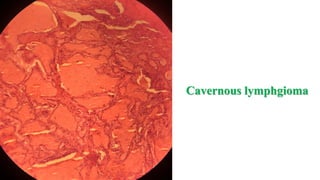 Cavernous lymphgioma