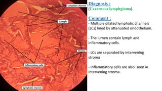 Diagnosis :
(Cavernous lymphgioma).
Comment :
- Multiple dilated lymphatic channels
(LCs) lined by attenuated endothelium.
- The lumen contain lymph and
inflammatory cells.
- LCs are separated by intervening
stroma
- Inflammatory cells are also seen in
intervening stroma.
Lymph
Inflammatory cells
Stroma
Lymphatic channel
Lymphatic channel