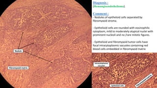 Diagnosis :
(Hemangioendothelioma).
Comment :
- Nodules of epitheloid cells separated by
fibromyxoid stroma.
- Epithelioid cells are rounded with eosinophilic
cytoplasm, mild to moderately atypical nuclei with
prominent nucleoli and no /rare mitotic figures.
- Epithelioid and fibromyxoid tumor cells have
focal intracytoplasmic vacuoles containing red
blood cells embedded in fibromyxoid matrix
Nodule
Fibromyxoid matrix
Intracytoplasmic
vacuoles
Epitheloid cells