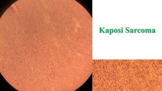 Kaposi Sarcoma
