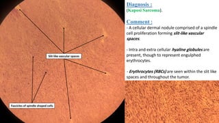 Diagnosis :
(Kaposi Sarcoma).
Comment :
- A cellular dermal nodule comprised of a spindle
cell proliferation forming slit-like vascular
spaces.
- Intra and extra cellular hyaline globules are
present, though to represent engulphed
erythrocytes.
- Erythrocytes (RBCs) are seen within the slit like
spaces and throughout the tumor.
Slit-like vascular spaces
Fascicles of spindle shaped cells
 
