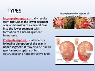 Birth canal injury in obstetrics and gynaecology.pptx