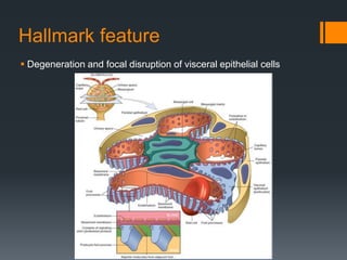 Hallmark feature
 Degeneration and focal disruption of visceral epithelial cells
 