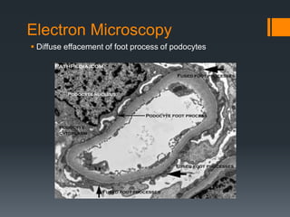 Electron Microscopy
 Diffuse effacement of foot process of podocytes
 