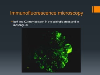 Immunofluorescence microscopy
 IgM and C3 may be seen in the sclerotic areas and in
mesangium
 