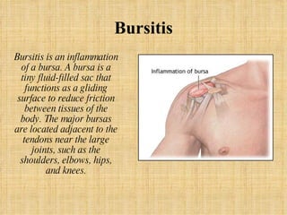 Bursitis Bursitis is an inflammation of a bursa. A bursa is a tiny fluid-filled sac that functions as a gliding surface to reduce friction between tissues of the body. The major bursas are located adjacent to the tendons near the large joints, such as the shoulders, elbows, hips, and knees. 