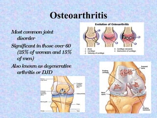 Osteoarthritis Most common joint disorder Significant in those over 60 (25% of woman and 15% of men) Also known as degenerative arthritis or DJD 