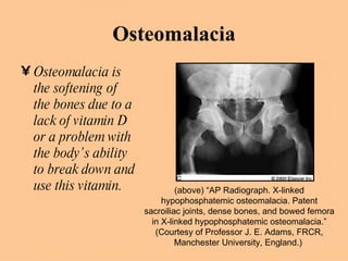 Osteomalacia Osteomalacia is the softening of the bones due to a lack of vitamin D or a problem with the body’s ability to break down and use this vitamin. (above) “AP Radiograph. X-linked hypophosphatemic osteomalacia. Patent sacroiliac joints, dense bones, and bowed femora in X-linked hypophosphatemic osteomalacia.” (Courtesy of Professor J. E. Adams, FRCR, Manchester University, England.)  