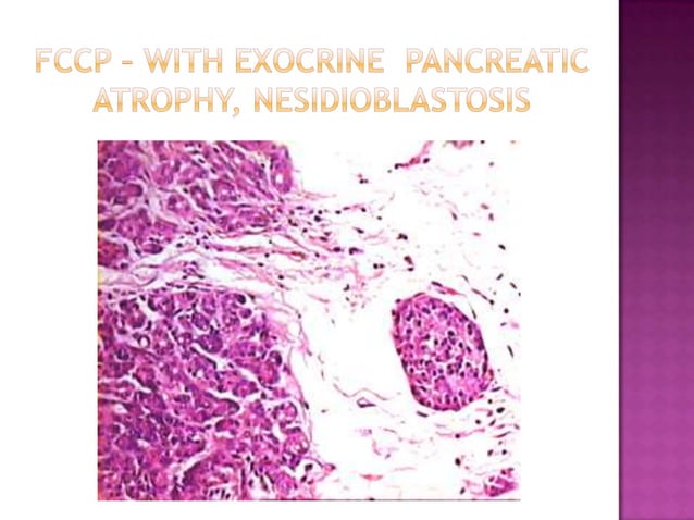 Islet cell Pathology | PPTX | Endocrine and Metabolic Diseases ...