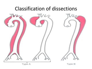 Dissection Classification Class Pathology of blood vessels | PPTX