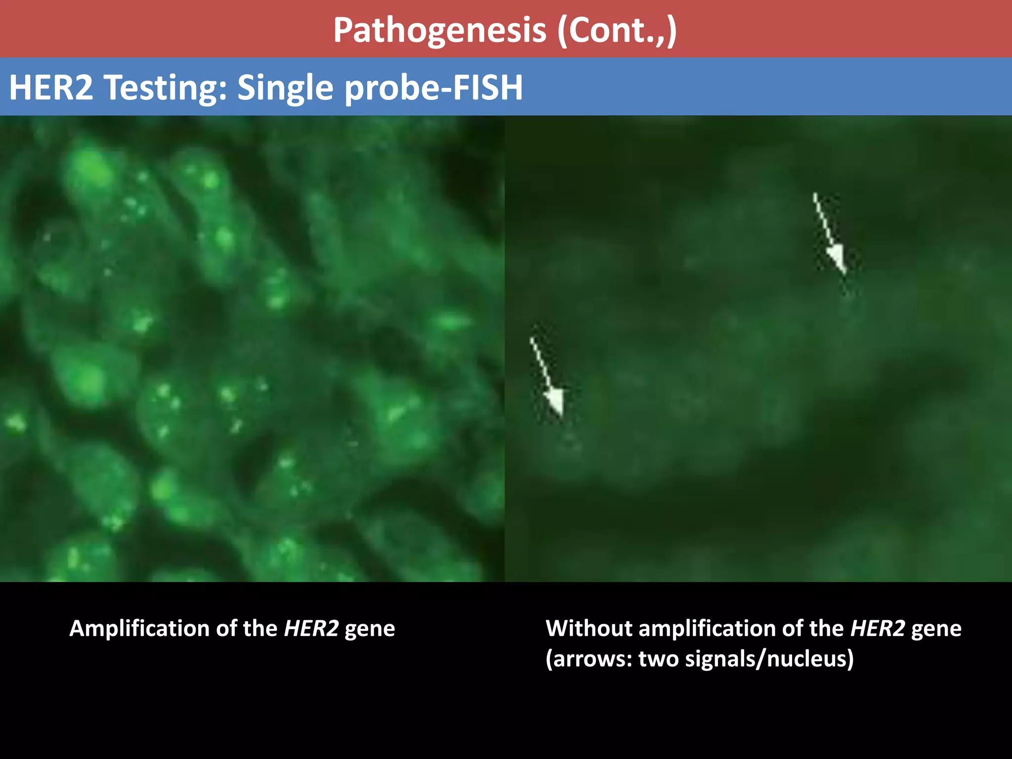 Pathology of breast cancer | PPTX