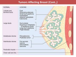 Preast Cancer Pathology of breast cancer | PPTX
