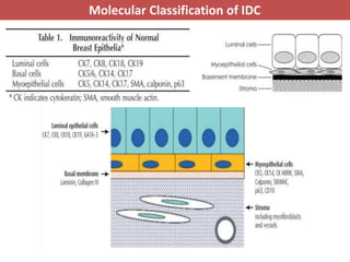 Idca Cancer Pathology of breast cancer | PPTX