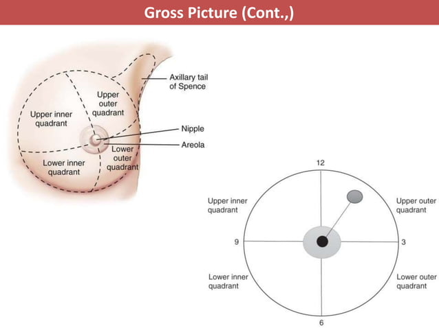 Pathology of breast cancer | PPTX
