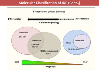 Idca Cancer Pathology of breast cancer | PPTX