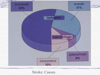 Stroke: Causes 
