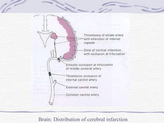 Brain: Distribution of cerebral infarction 