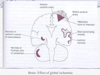 Brain: Effect of global ischaemia 