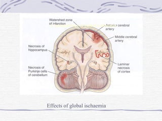 Consequences of global ischaemia Effects of global ischaemia 