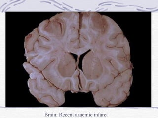 Brain: Recent anaemic infarct 