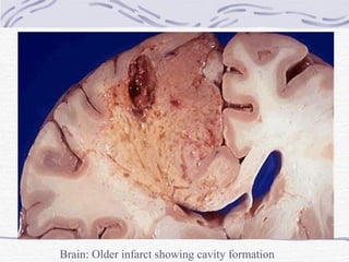 Brain: Older infarct showing cavity formation 