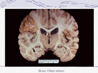 Brain: Older infarct 