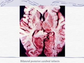 Bilateral posterior cerebral infarcts 