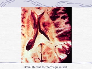 Brain: Recent haemorrhagic infarct 