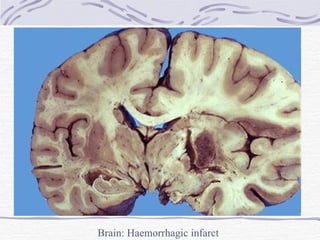Brain: Haemorrhagic infarct 