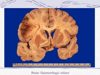 Brain: Haemorrhagic infarct 