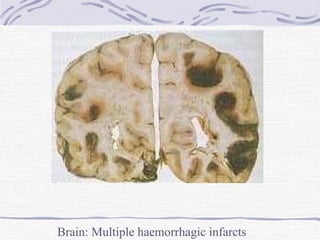 Brain: Multiple haemorrhagic infarcts 