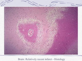 Brain: Relatively recent infarct - Histology 