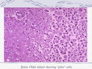 Brain: Older infarct showing ‘gitter’ cells 