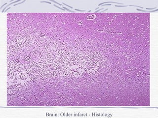 Brain: Older infarct - Histology 