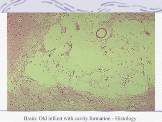 Brain: Old infarct with cavity formation - Histology 