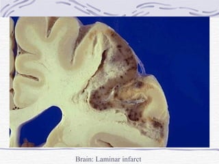 Brain: Laminar infarct 