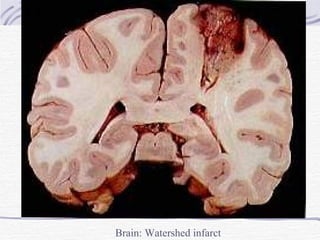 Brain: Watershed infarct 