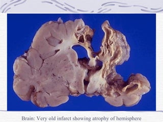 Brain: Very old infarct showing atrophy of hemisphere 