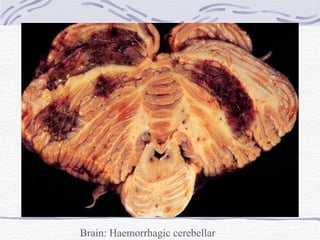 Brain: Haemorrhagic cerebellar infarcts 