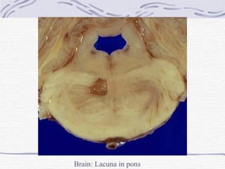 Brain: Lacuna in pons 