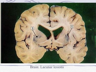 Brain: Lacunar lesions 