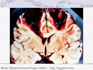 Brain: Bilateral haemorrhagic infarct – Sup. Saggital sinus thrombosis 