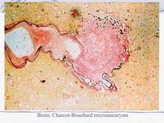 Brain: Charcot-Bouchard microaneurysm 